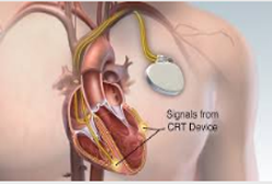 Aicd Implantation