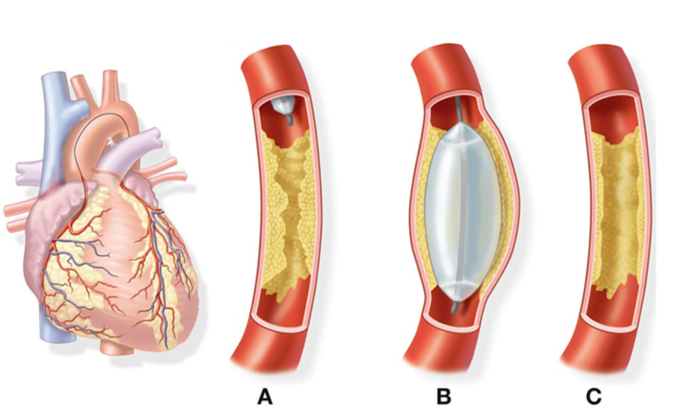 Heart Blockage